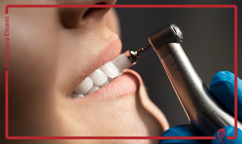 عوارض احتمالی جرم گیری بیش از حد دندان ها